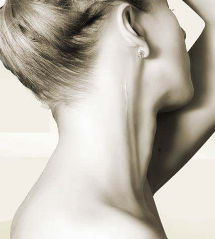 Frau mit Narbe am Hals – Narbenkorrektur in Tübingen