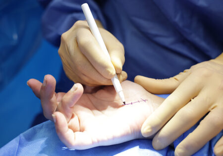 Morbus Dupuytren: Übungen zur Linderung der Beschwerden