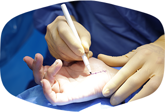 Morbus Dupuytren: Übungen zur Linderung der Beschwerden