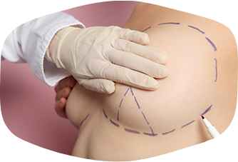 Brustverkleinerung: Narben und die beste Heilung