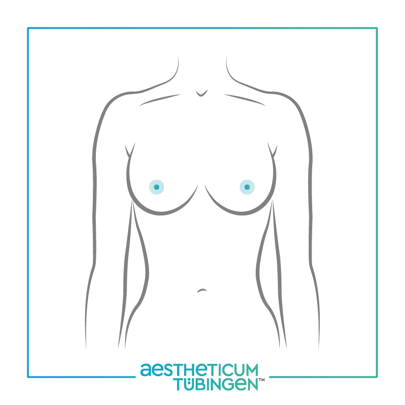 Brustverkleinerung bei Stuttgart: Darstellung zeigt Oberkörper nachher