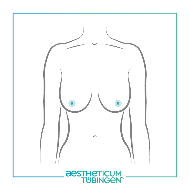 Brustverkleinerung bei Stuttgart: Darstellung zeigt Oberkörper vorher