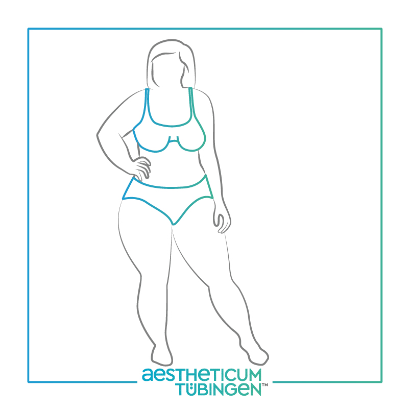 Lipödem OP bei Stuttgart: Darstellung vorher zeigt einen größeren Körper