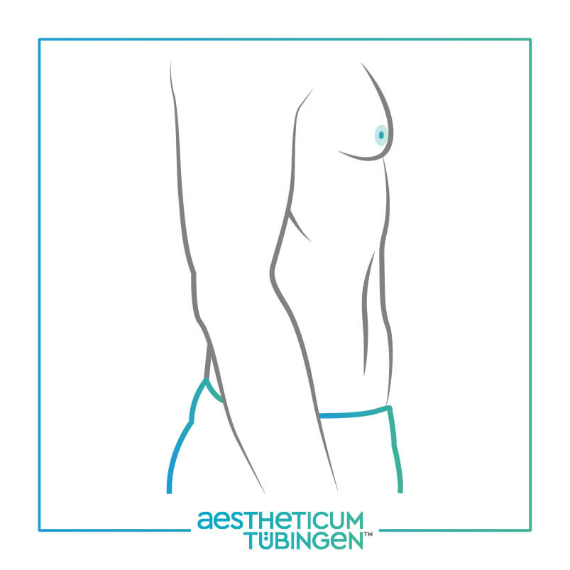 Fettabsaugung bei Stuttgart: Darstellung definierten Bauch nachher