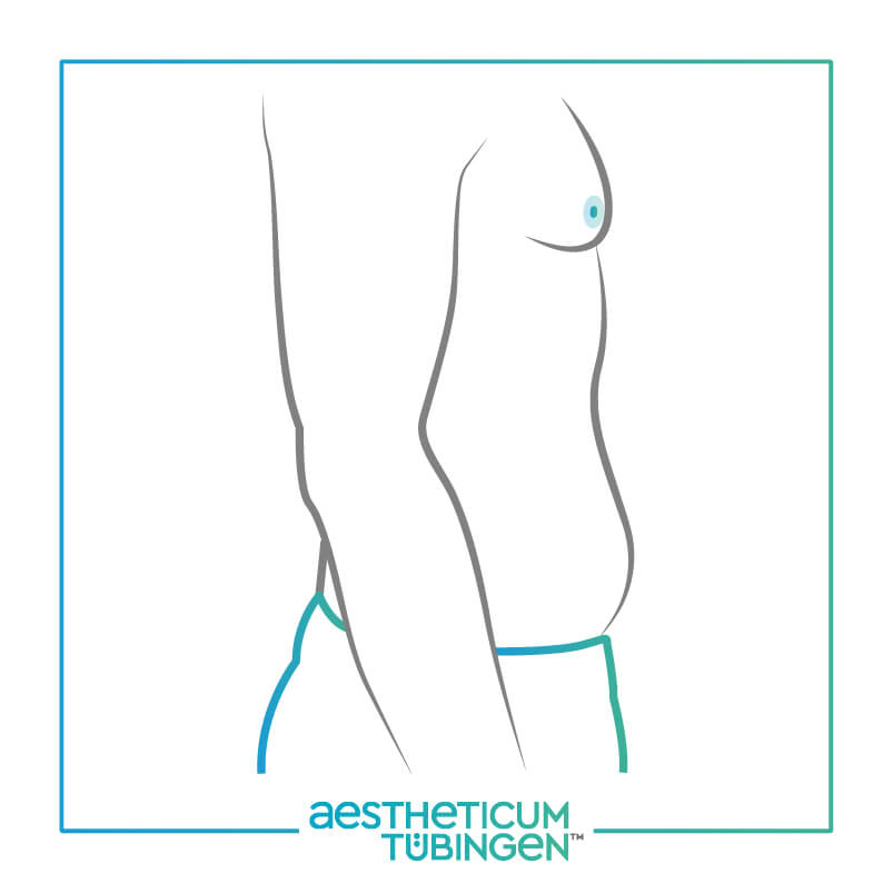 Fettabsaugung bei Stuttgart: Darstellung zeigt Bauchansatz vorher
