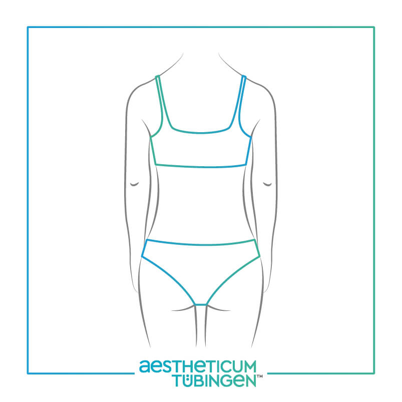 Liposuktion bei Stuttgart: Darstellung nachher zeigt einen größeren Körper