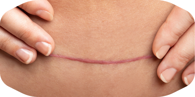 Narbenbehandlung mit dem Narbicum-Konzept